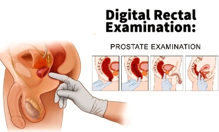 digital rectal examination
